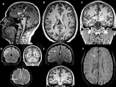 Broadening the Spectrum of Adulthood X-Linked Adrenoleukodystrophy: A Report of Two Atypical Cases